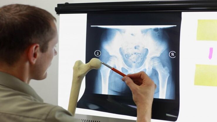 Doctor examines x-ray for hip osteoarthritis